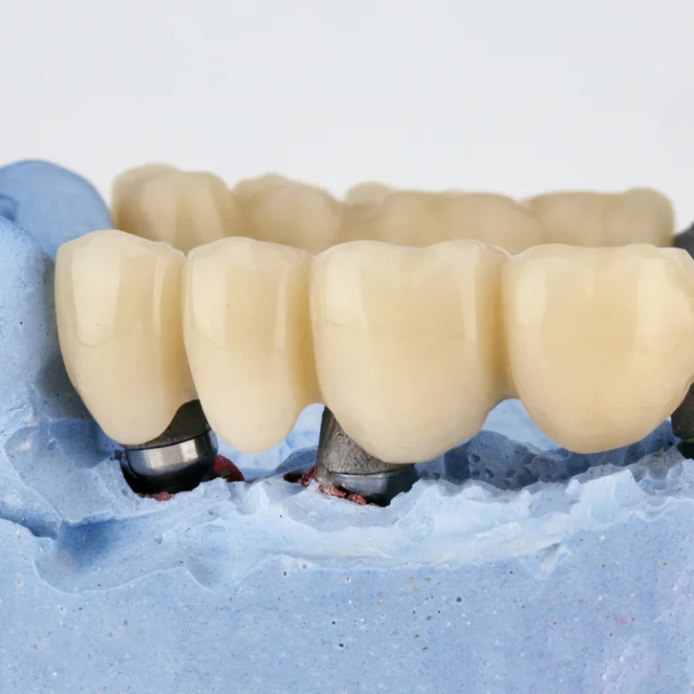 Dental Bridges 