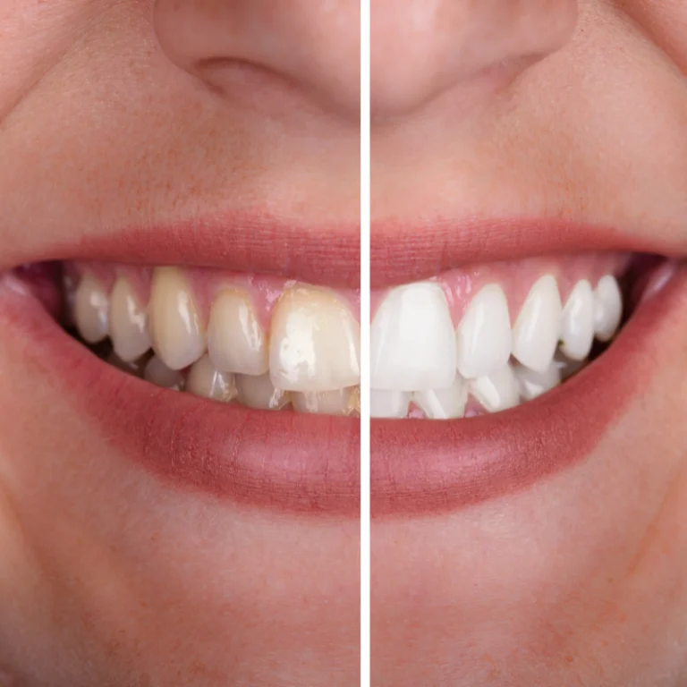 Teeth Whitening